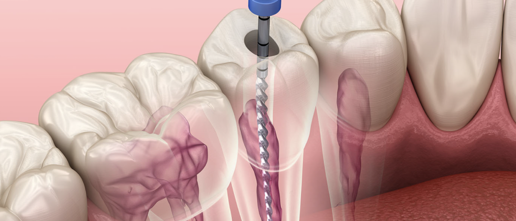 Endodoncia en Cuernavaca