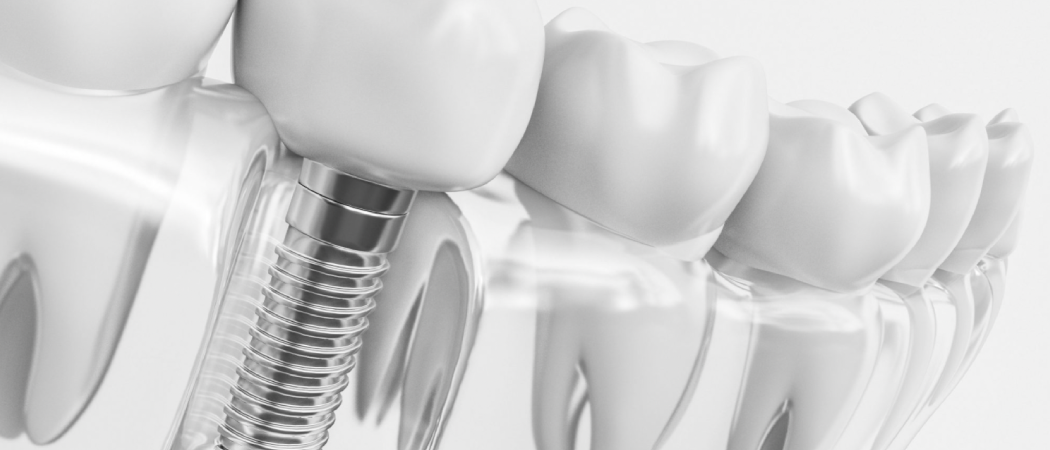 Implantes Dentales en Cuernavaca